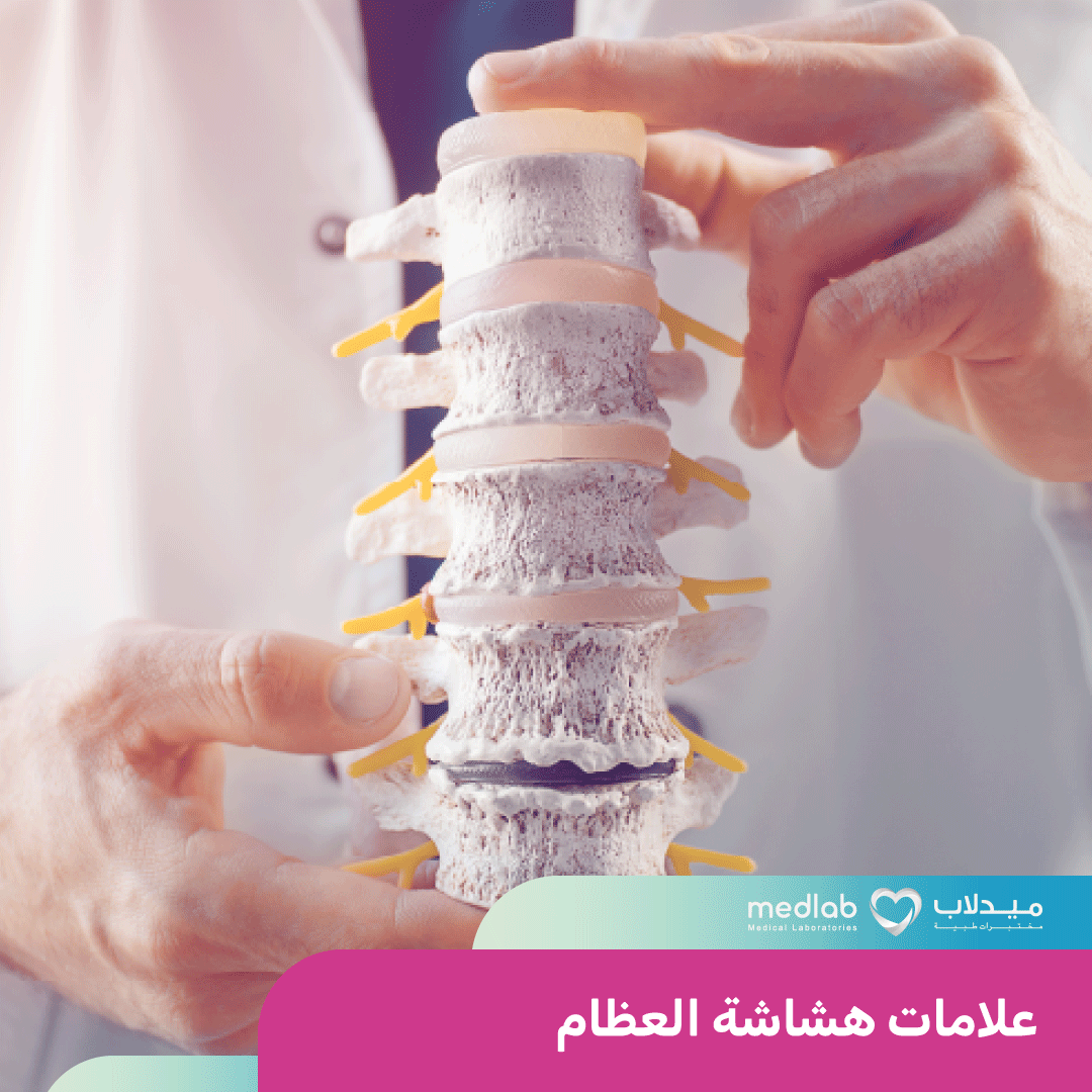 هشاشة العظام: تشخيص، علامات، ووسائل الوقاية